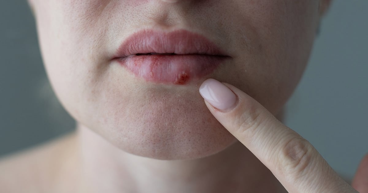 Después de casi treinta años, una nueva píldora para los casos de herpes que no cedían a nada