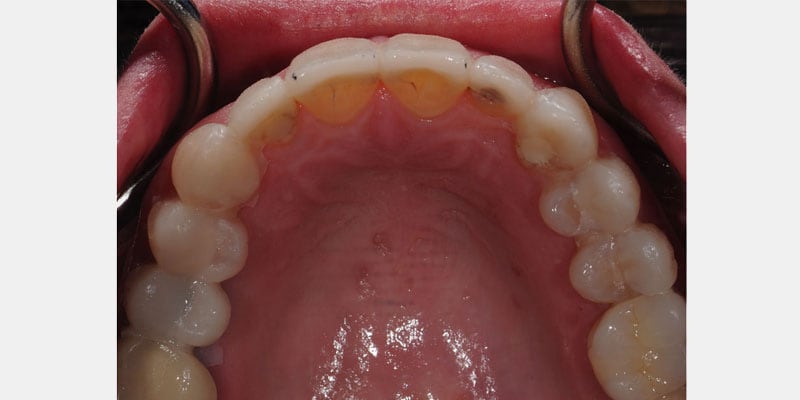 Carillas dentales: las filtraciones que nadie ve y que pueden terminar en una corona